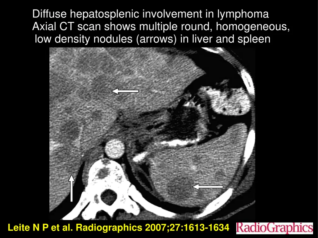 diffuse hepatosplenic involvement in lymphoma