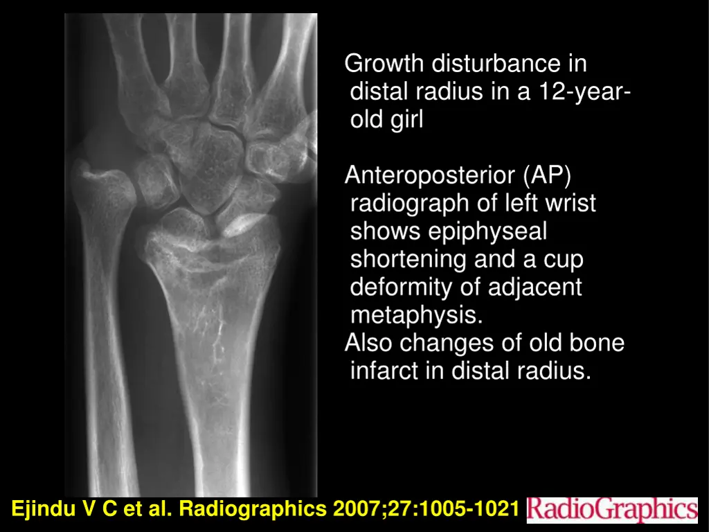 growth disturbance in distal radius in a 12 year