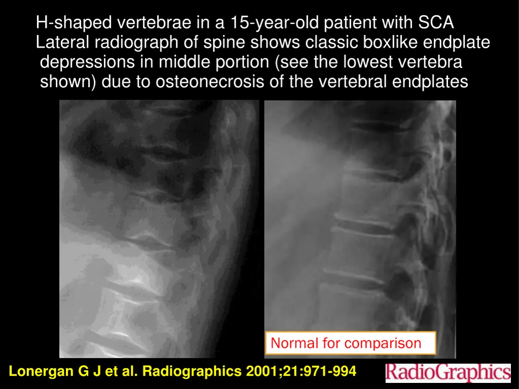 h shaped vertebrae in a 15 year old patient with