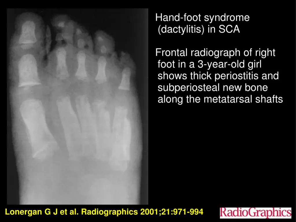 hand foot syndrome dactylitis in sca