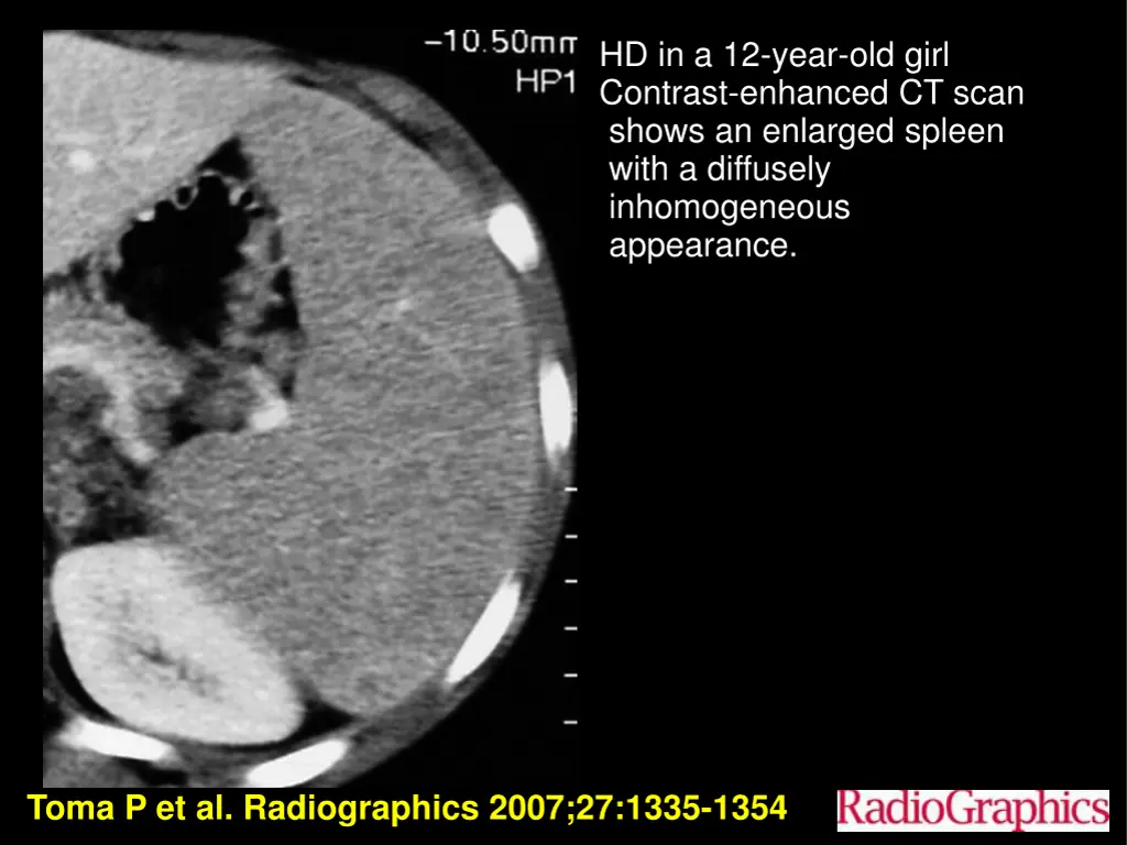 hd in a 12 year old girl contrast enhanced