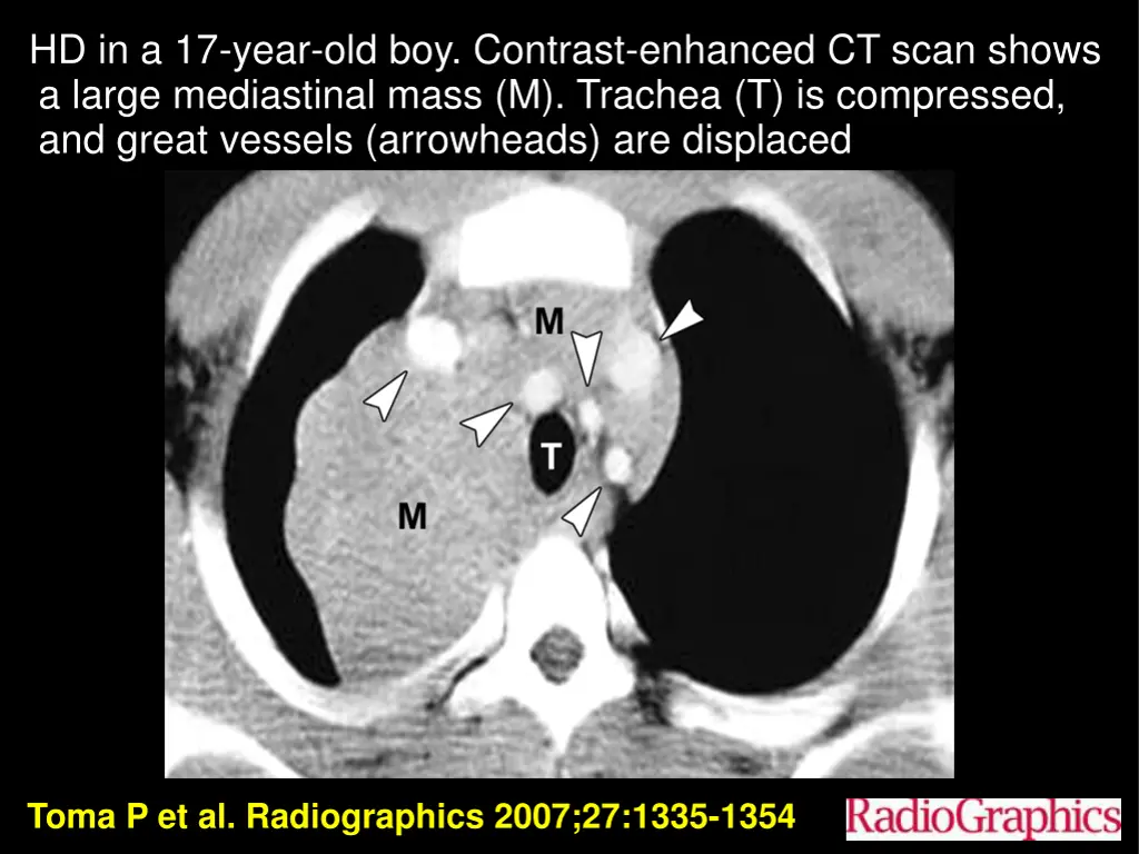 hd in a 17 year old boy contrast enhanced ct scan