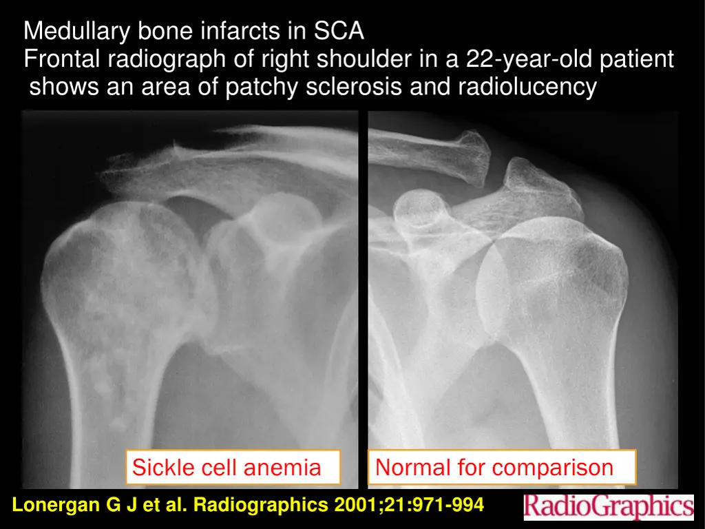 medullary bone infarcts in sca frontal radiograph