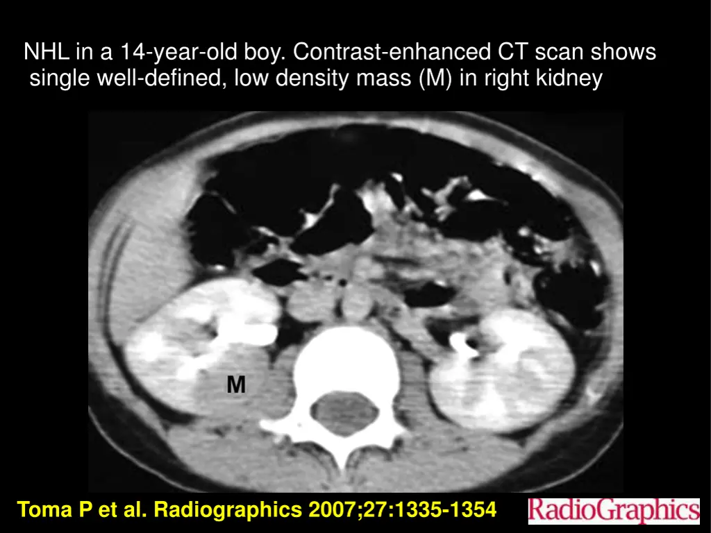 nhl in a 14 year old boy contrast enhanced 1