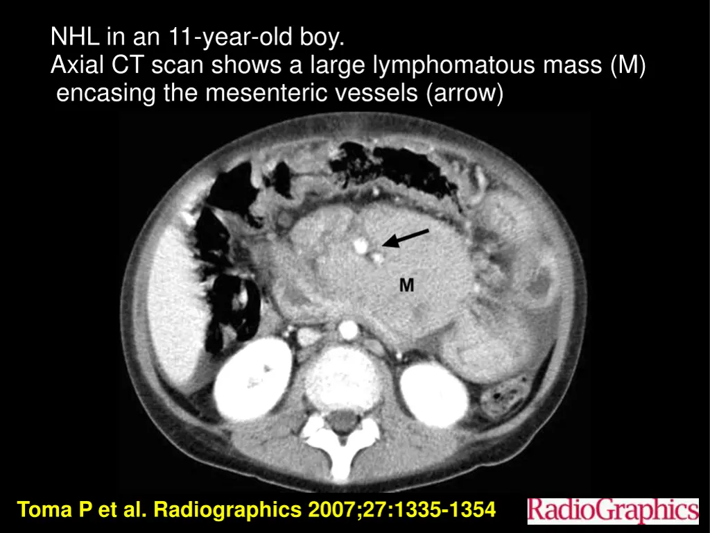 nhl in an 11 year old boy axial ct scan shows