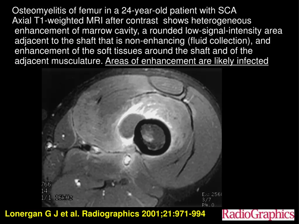 osteomyelitis of femur in a 24 year old patient