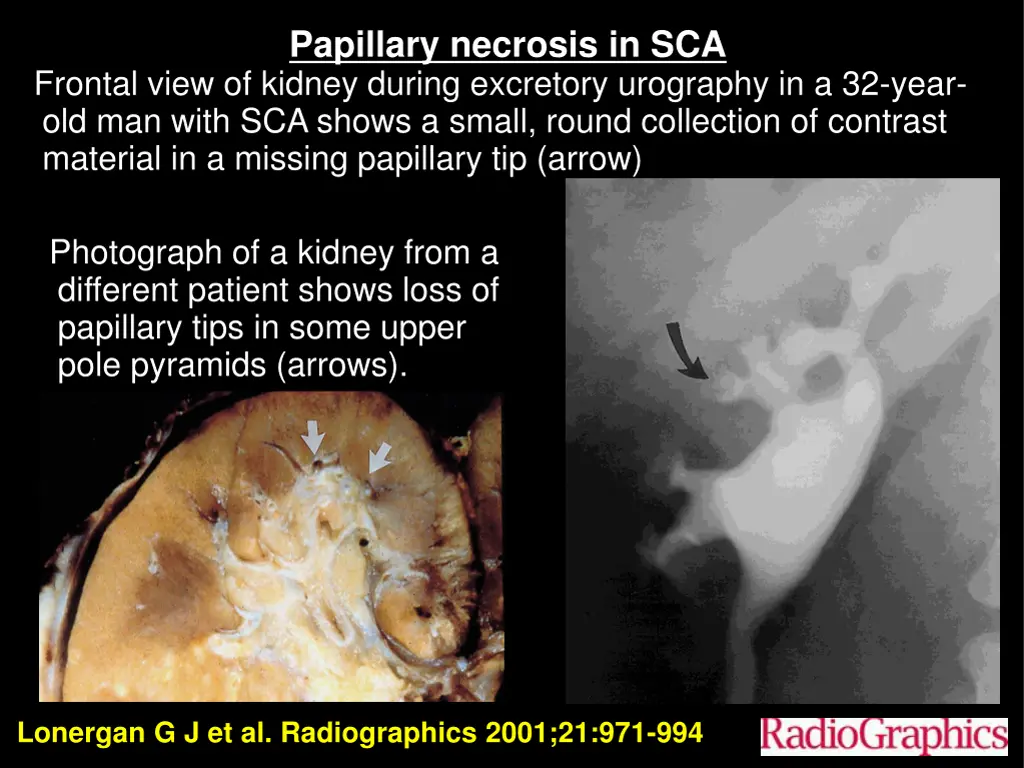 papillary necrosis in sca