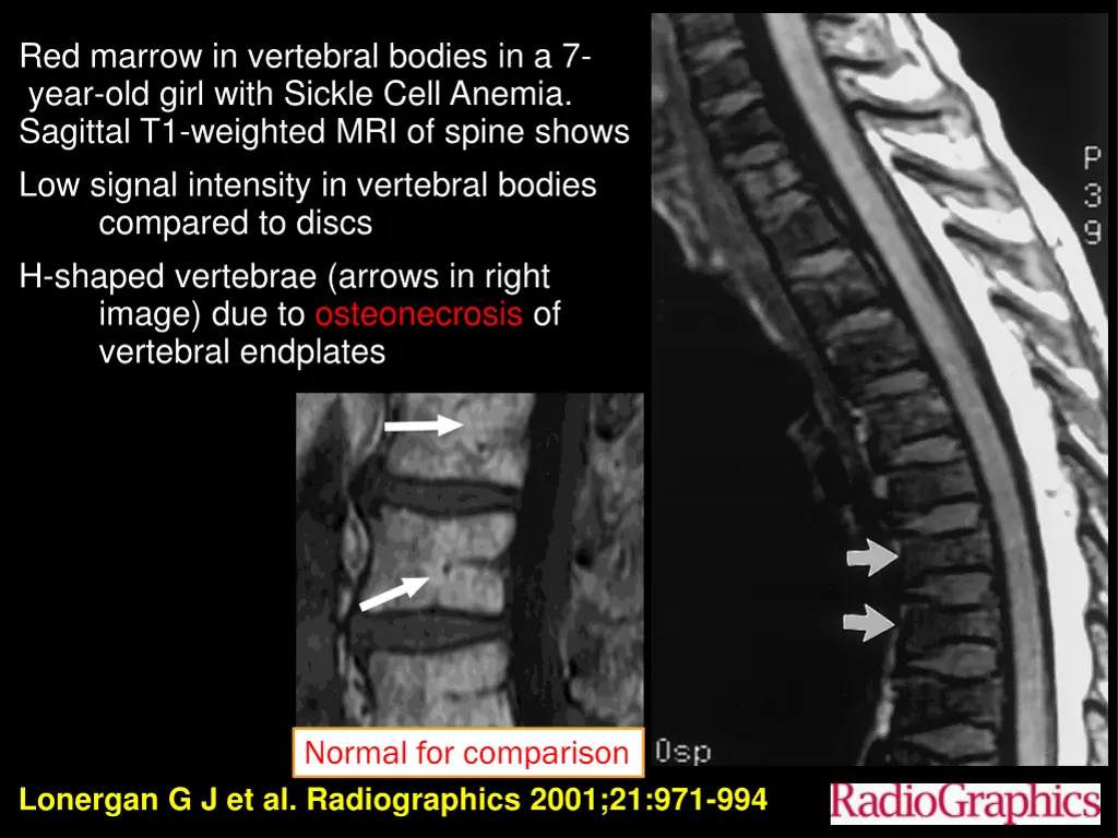 red marrow in vertebral bodies in a 7 year