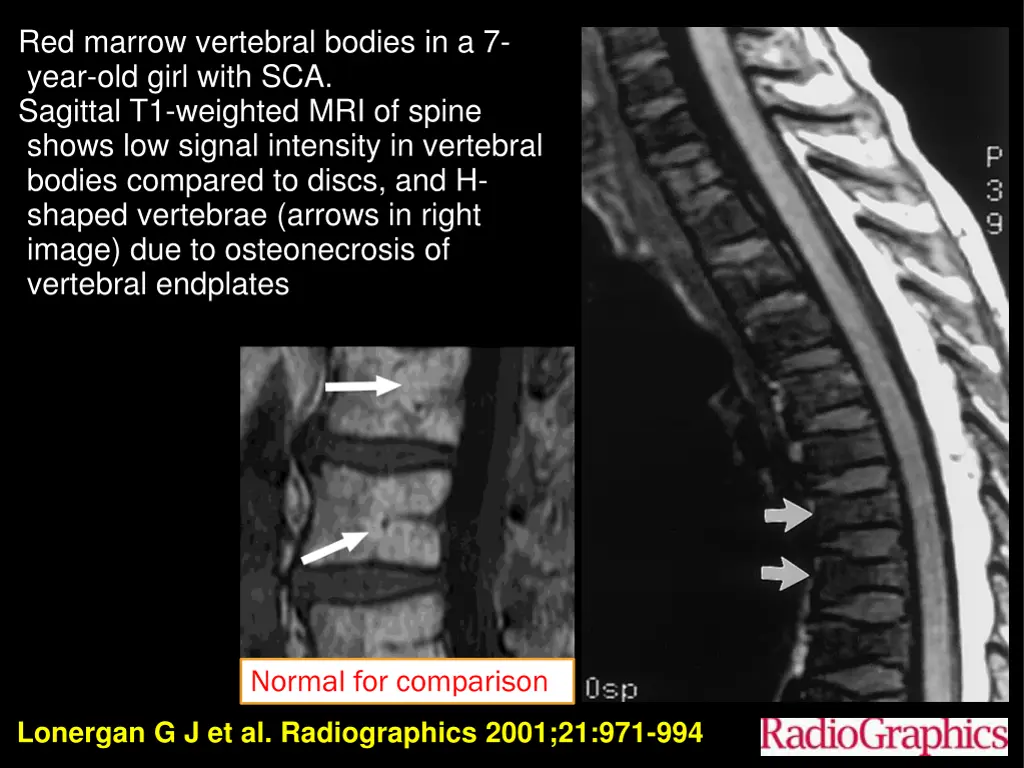 red marrow vertebral bodies in a 7 year old girl