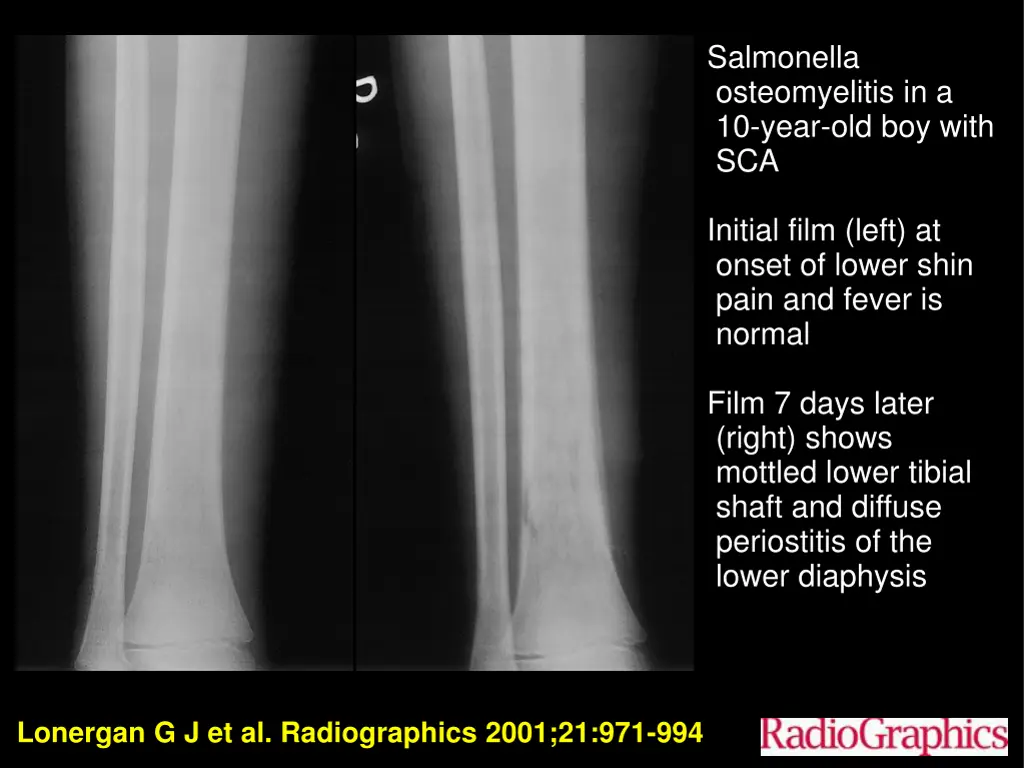 salmonella osteomyelitis in a 10 year