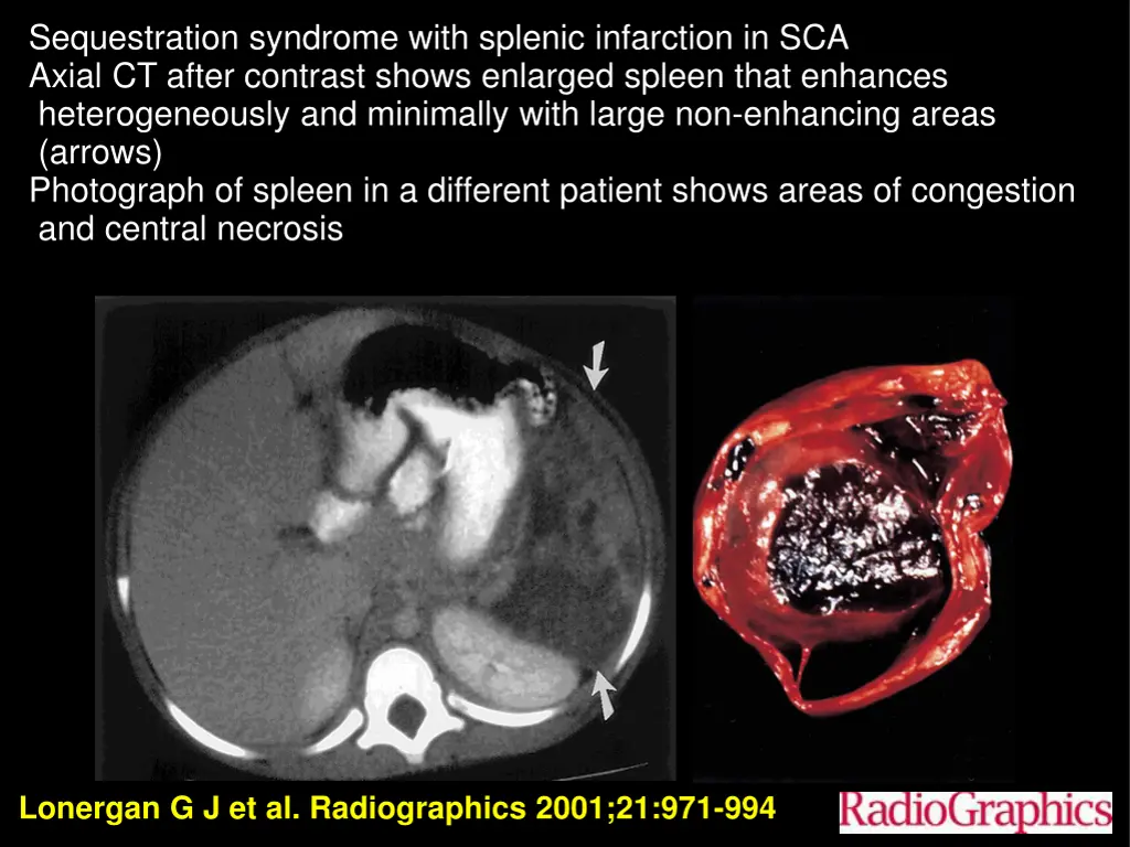 sequestration syndrome with splenic infarction