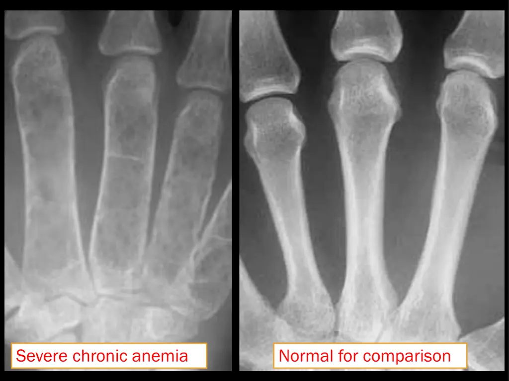 severe chronic anemia