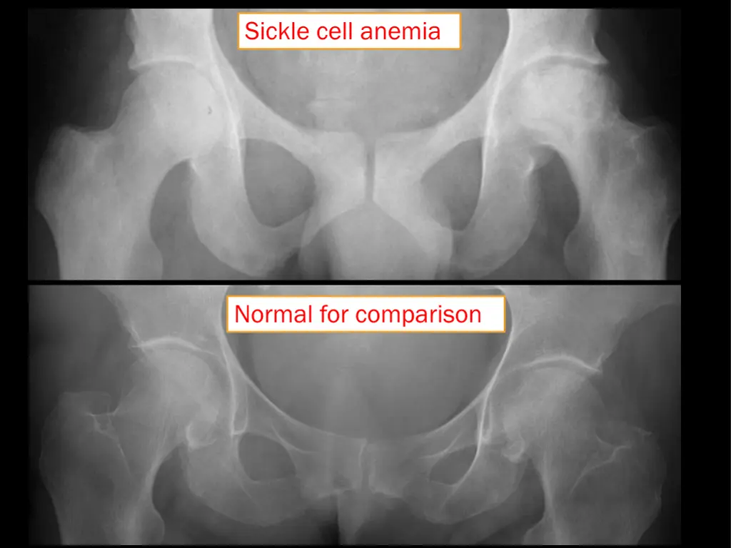 sickle cell anemia