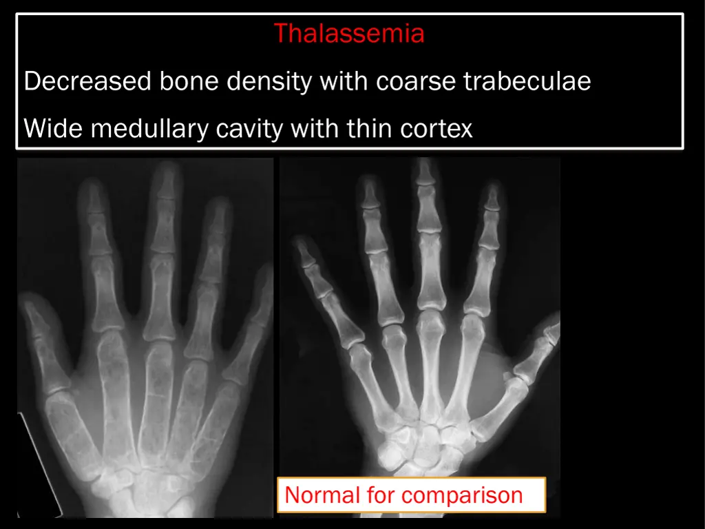 thalassemia