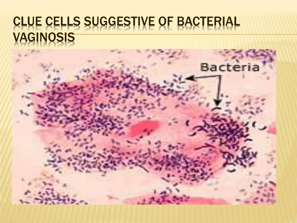 clue cells suggestive of bacterial vaginosis