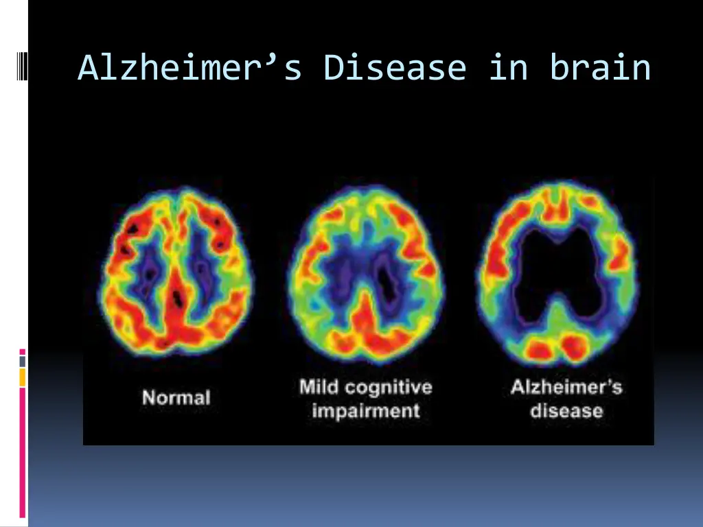 alzheimer s disease in brain