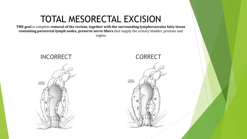 total mesorectal excision tme goal is complete