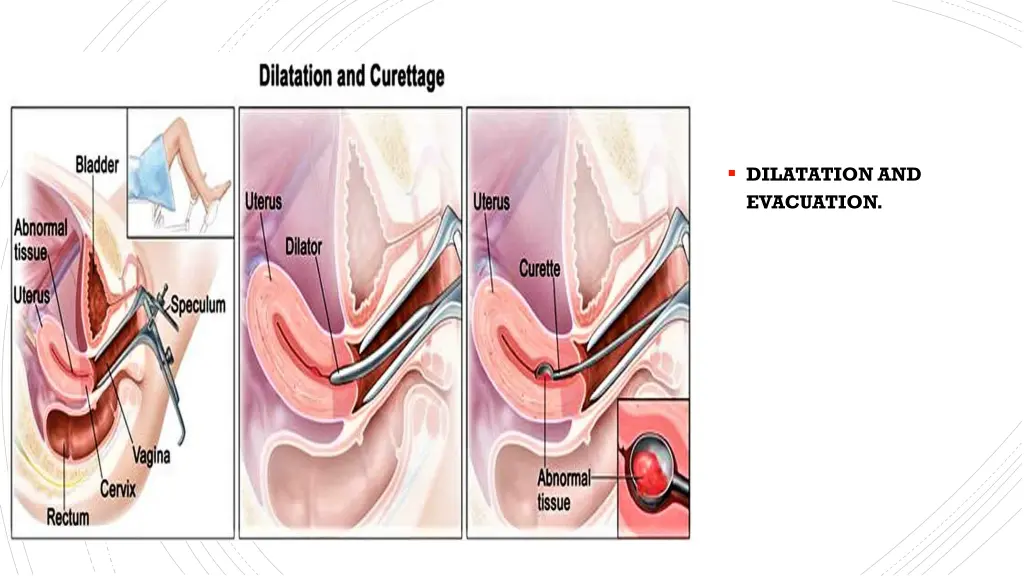 dilatation and evacuation