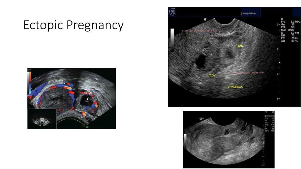 ectopic pregnancy