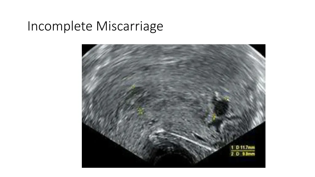 incomplete miscarriage