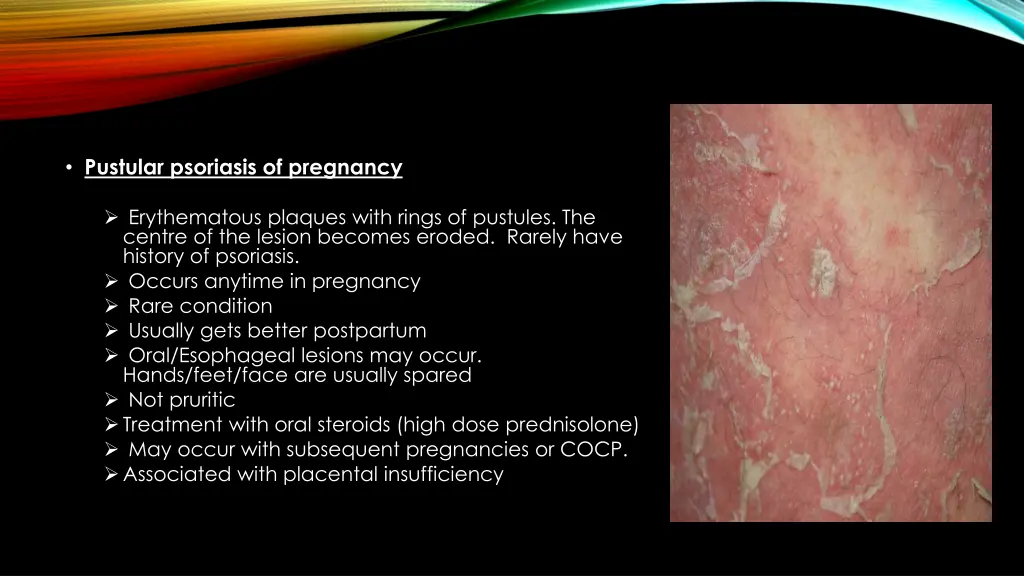 pustular psoriasis of pregnancy