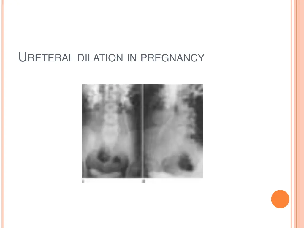 u reteral dilation in pregnancy