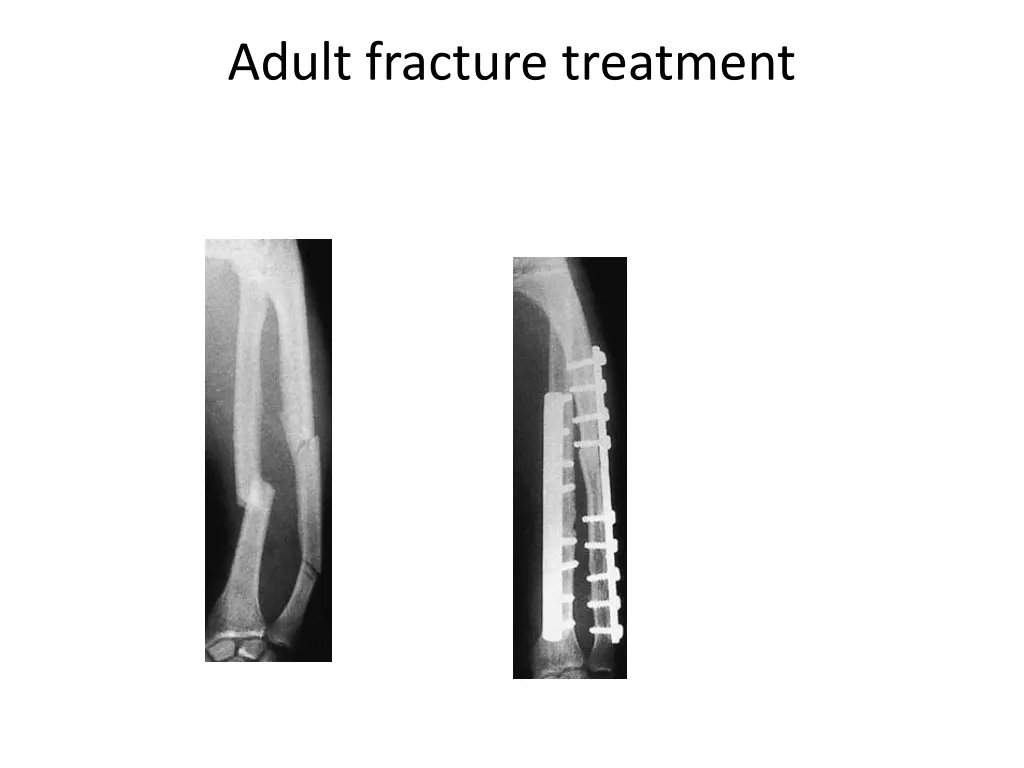 adult fracture treatment