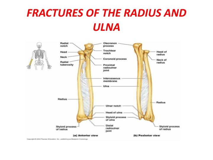 fractures of the radius and ulna