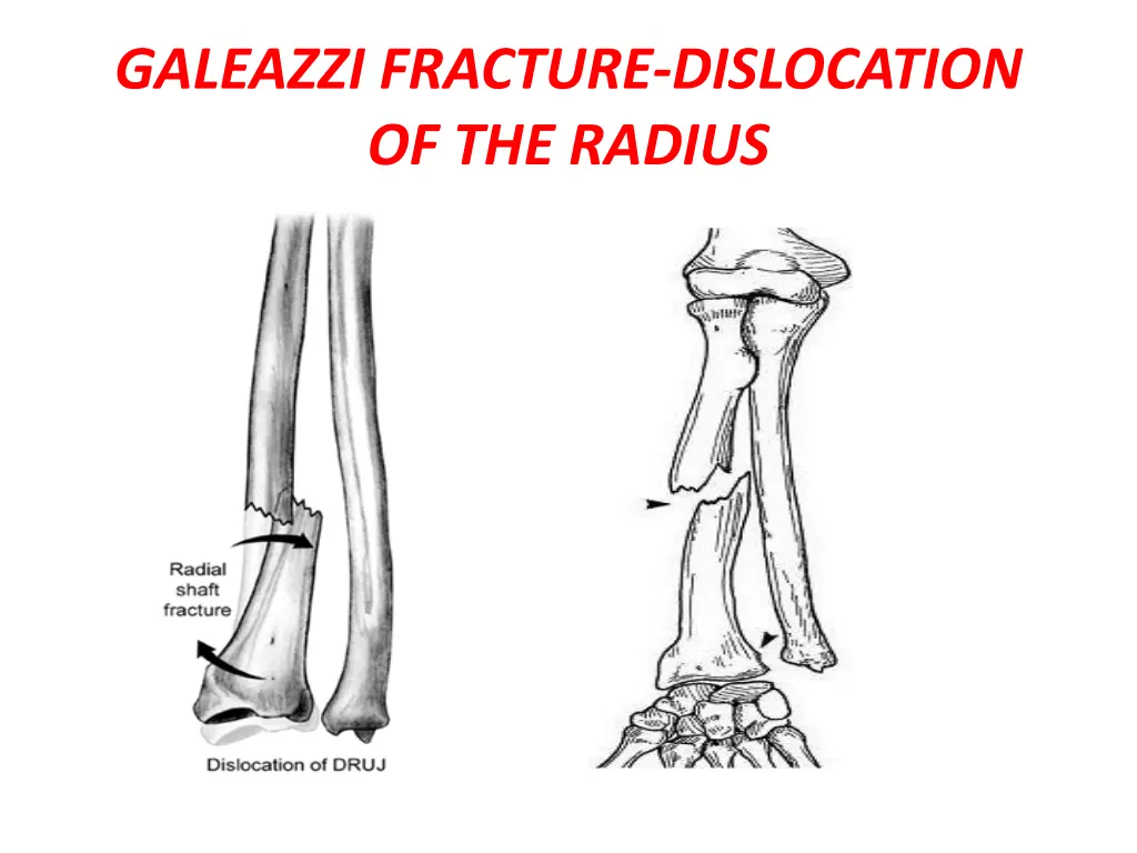 galeazzi fracture dislocation of the radius 1