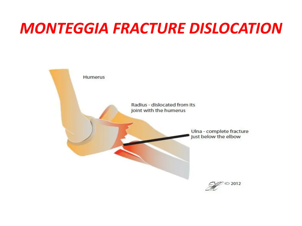 monteggia fracture dislocation