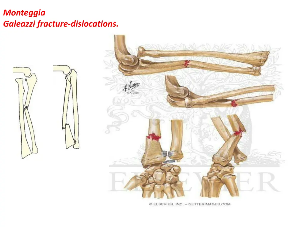 monteggia galeazzi fracture dislocations