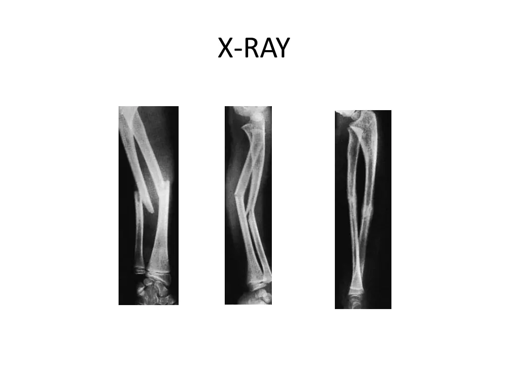 x ray 1