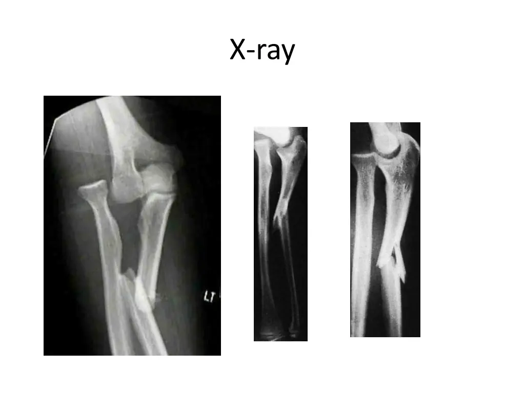 x ray 3