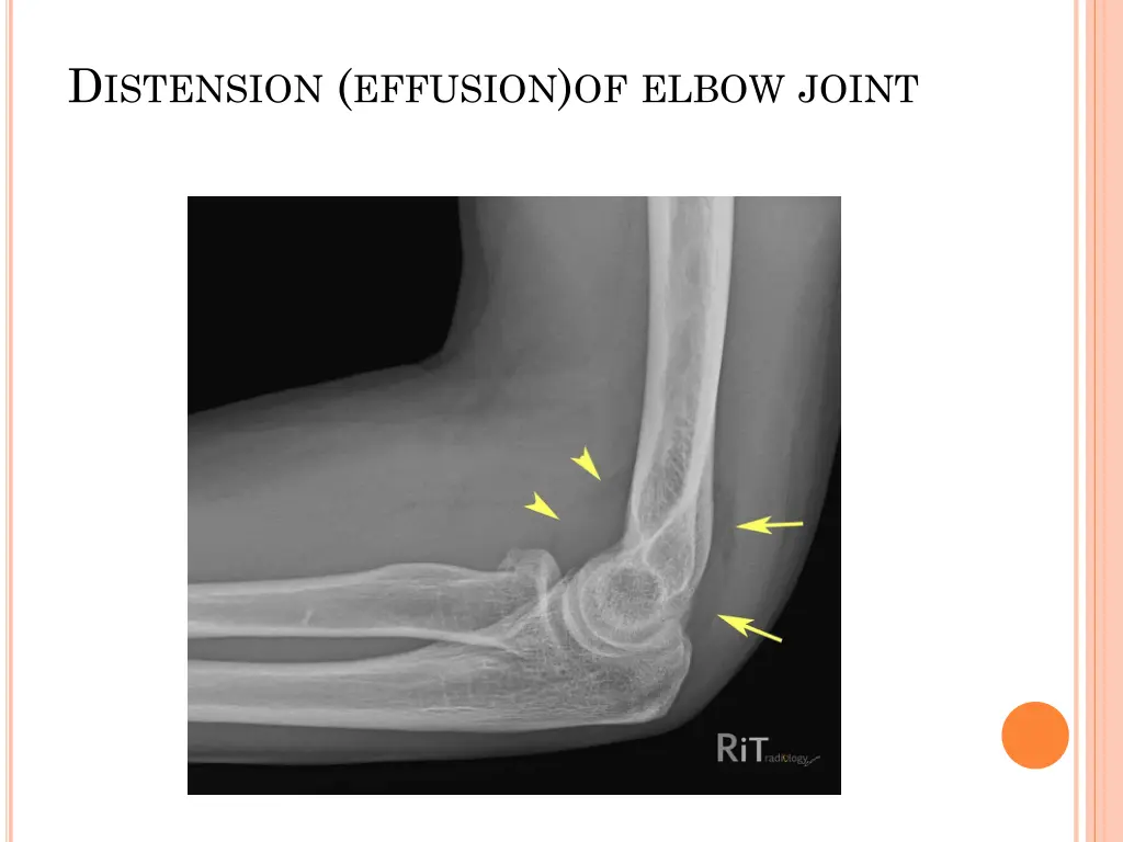 d istension effusion of elbow joint