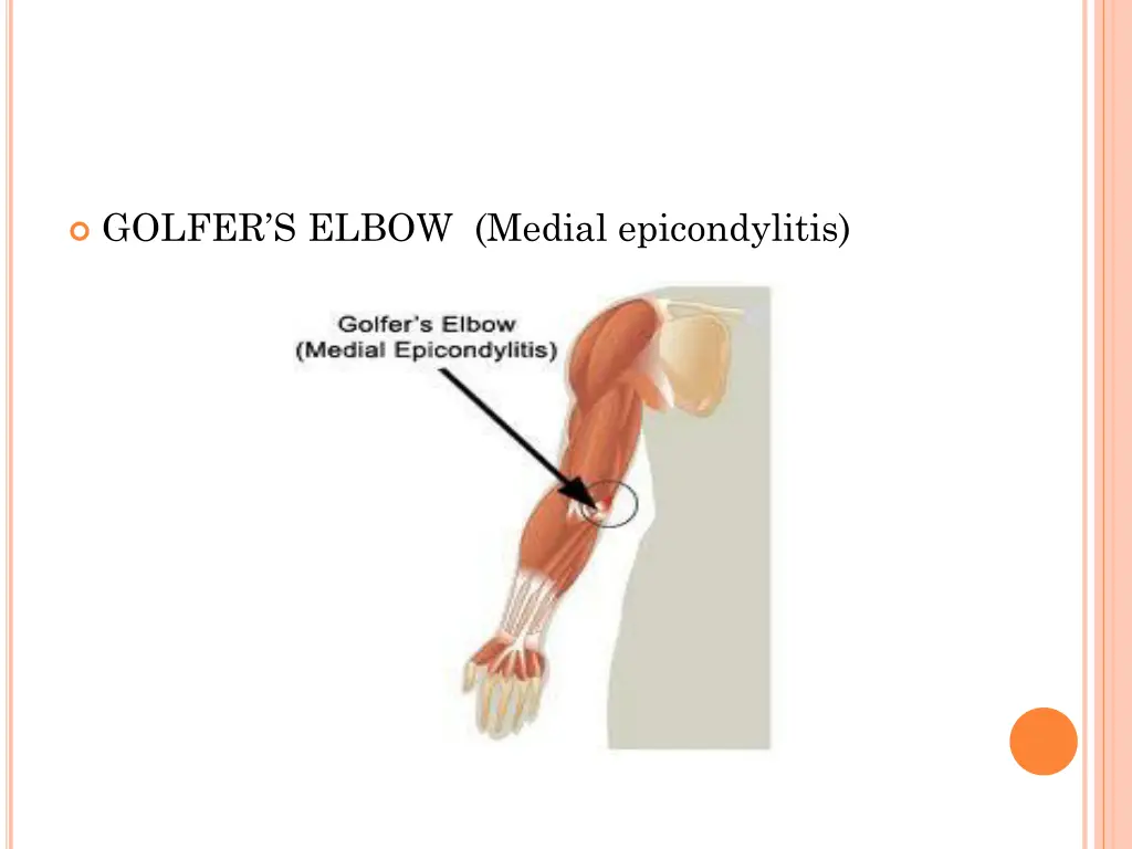 golfer s elbow medial epicondylitis