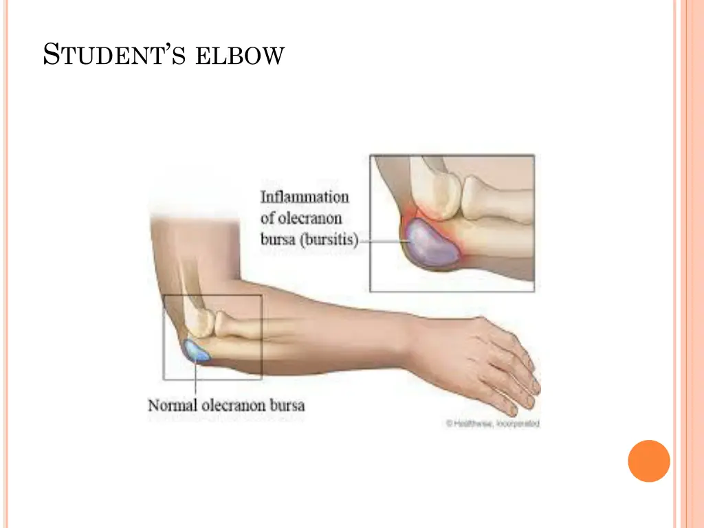 s tudent s elbow