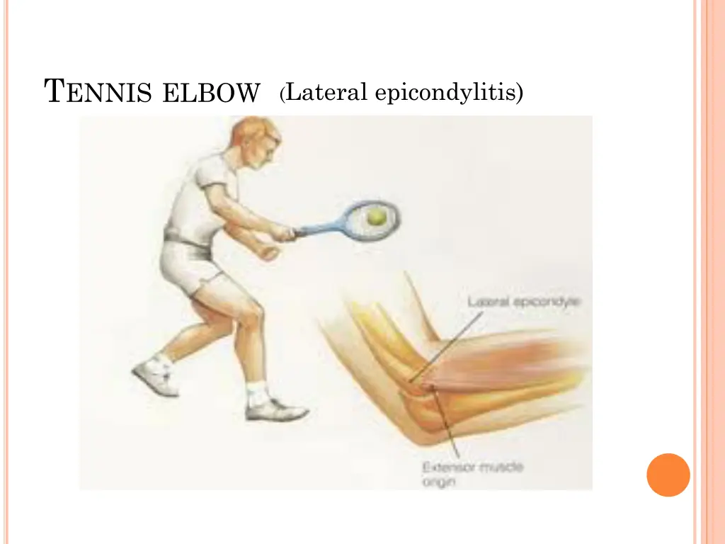 t ennis elbow