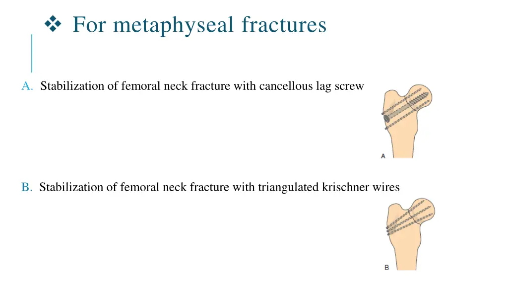 for metaphyseal fractures