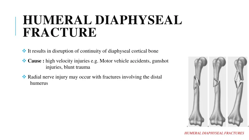 humeral diaphyseal fracture