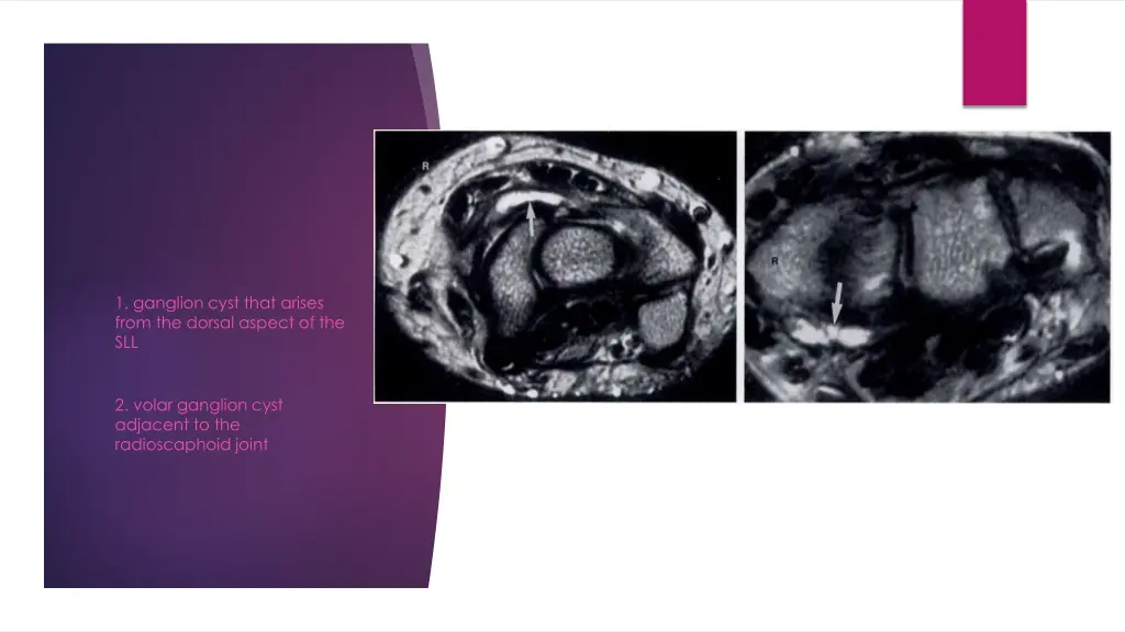 1 ganglion cyst that arises from the dorsal