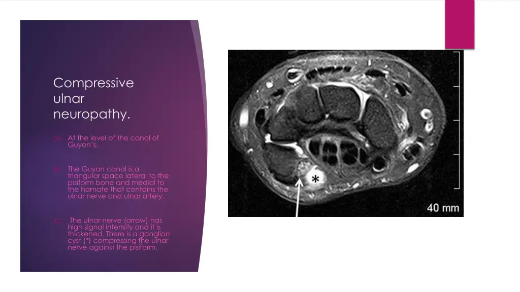 compressive ulnar neuropathy