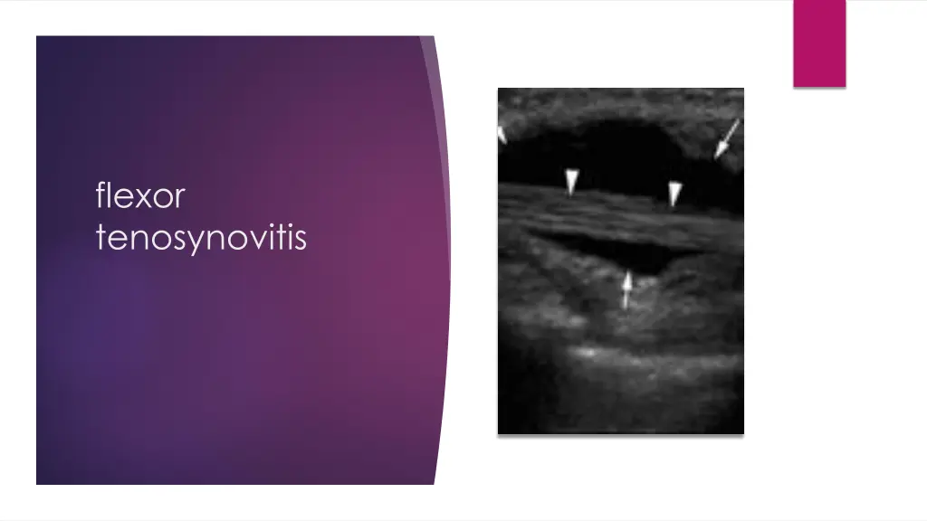 flexor tenosynovitis