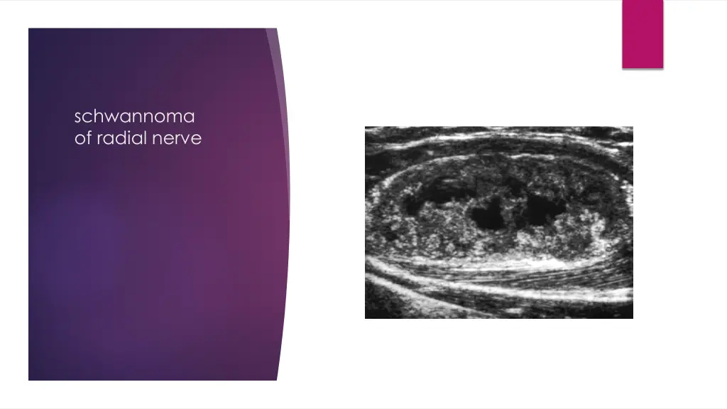 schwannoma of radial nerve