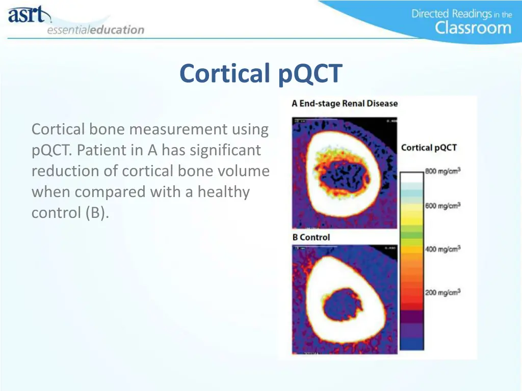 cortical pqct