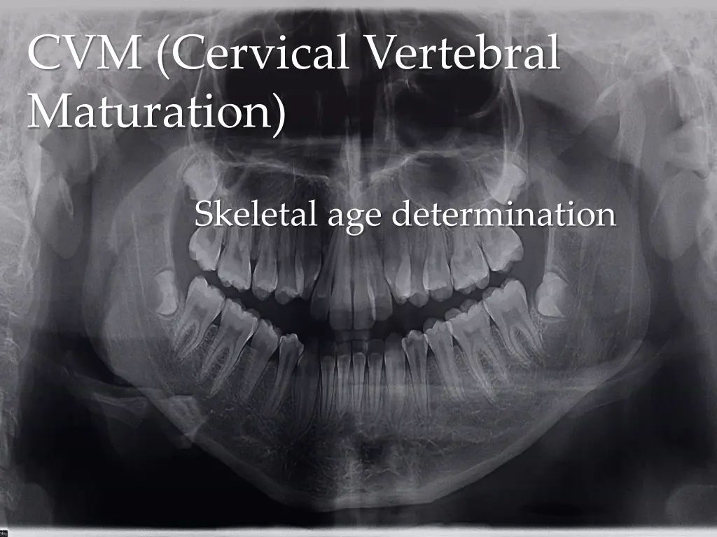 cvm cervical vertebral maturation