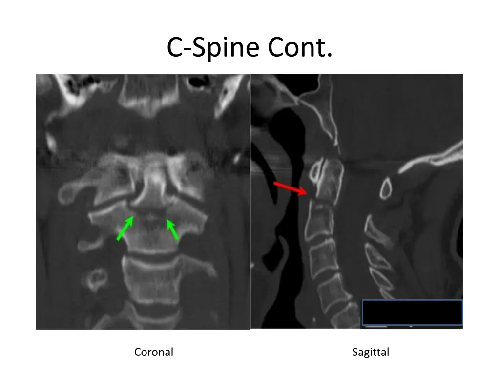 c spine cont