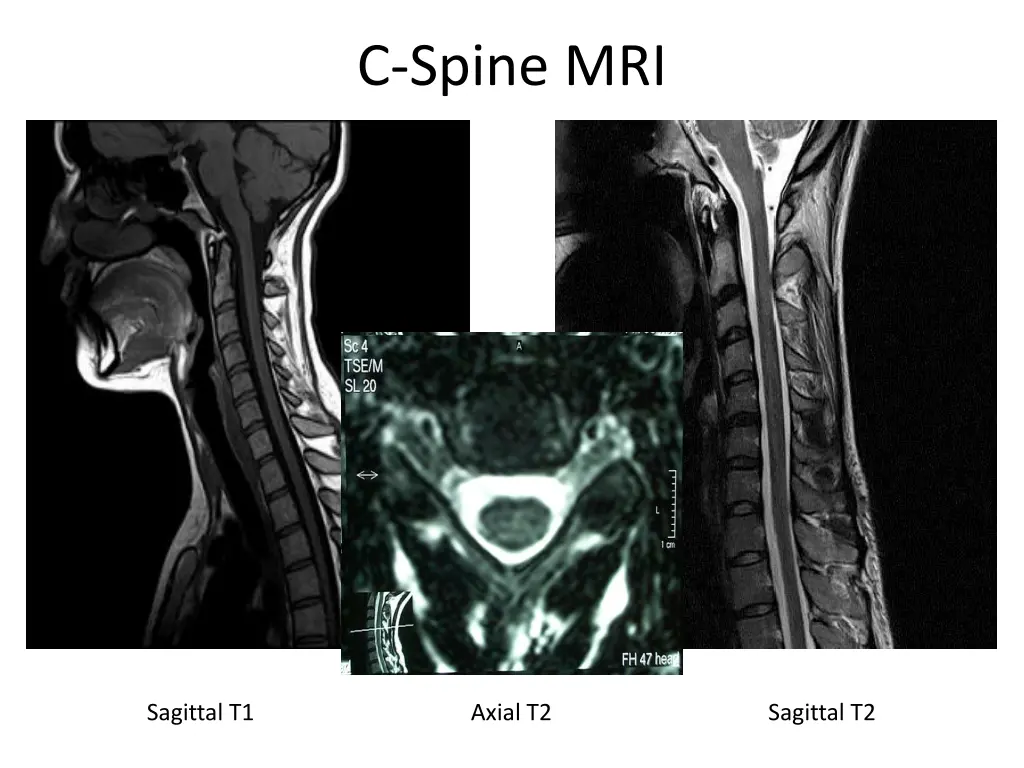 c spine mri