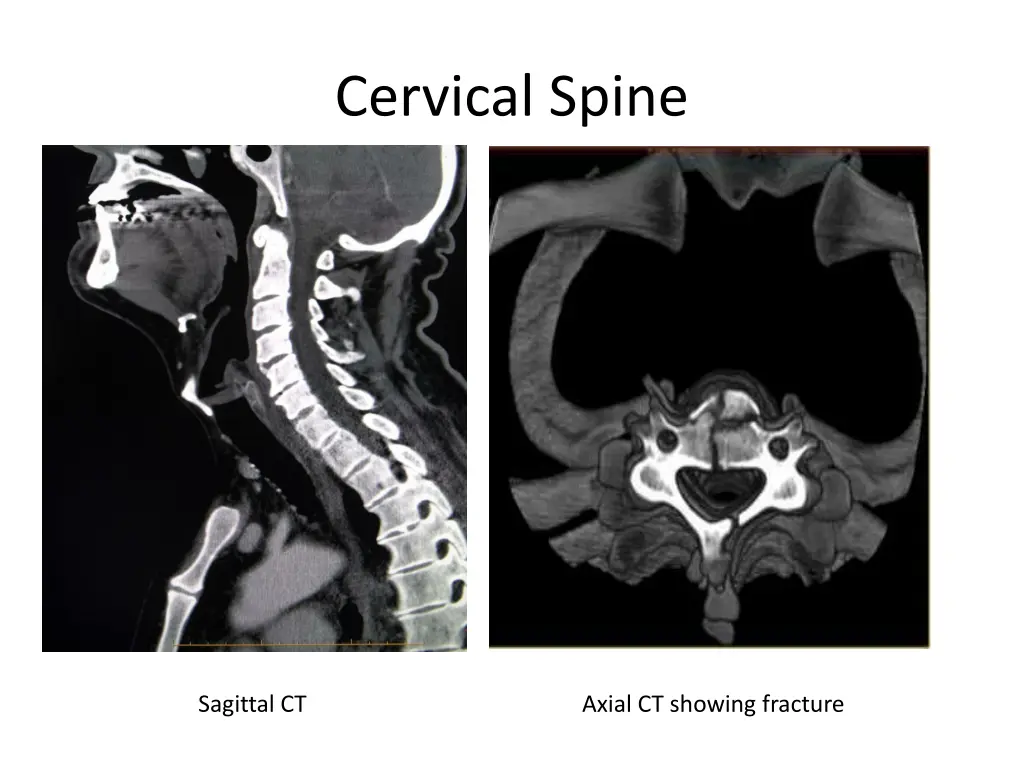 cervical spine