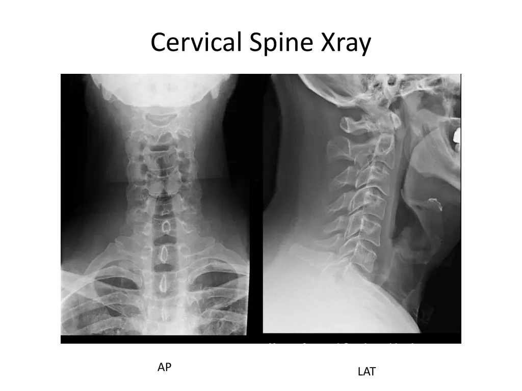 cervical spine xray