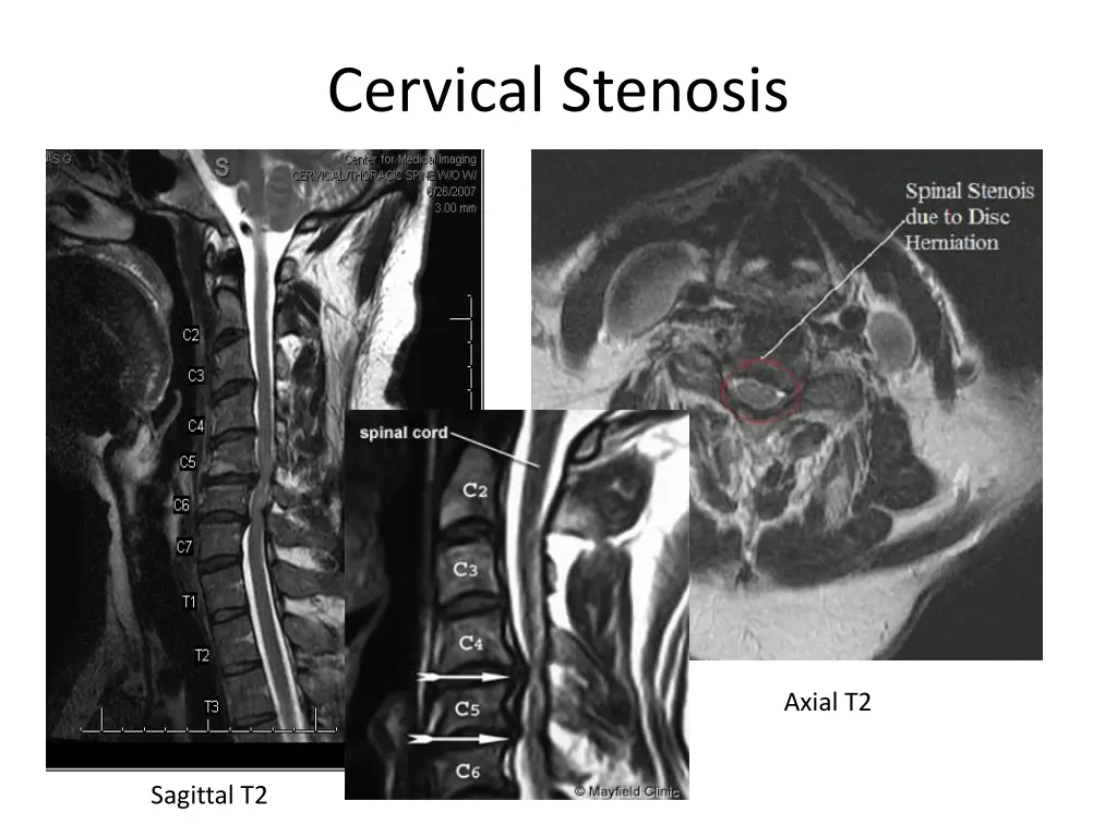 cervical stenosis